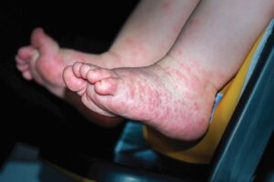 Procedure for Legal and Other Requirements 8 HFMD Rashes 2ss